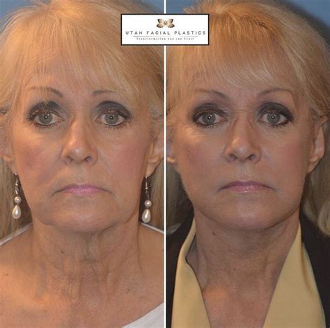 spiro plastic surgery photos|top facelift surgeons near me.